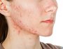 Diet and acne – is there a connection?